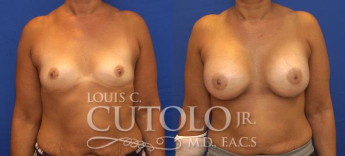 Before & After Breast Augmentation Case 84 View #1 View in Brooklyn, Staten Island, Queens, NY