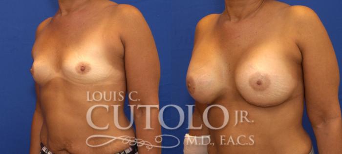 Before & After Breast Augmentation Case 84 View #2 View in Brooklyn, Staten Island, Queens, NY