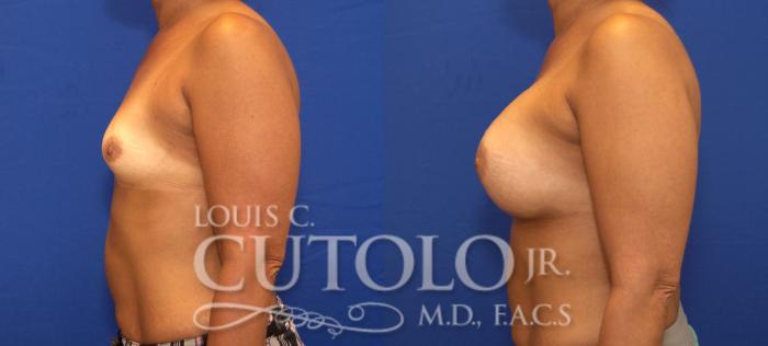 Before & After Breast Augmentation Case 84 View #3 View in Brooklyn, Staten Island, Queens, NY