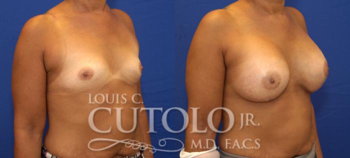 Before & After Breast Augmentation Case 84 View #4 View in Brooklyn, Staten Island, Queens, NY