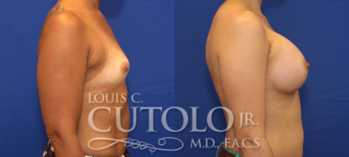Before & After Breast Augmentation Case 84 View #5 View in Brooklyn, Staten Island, Queens, NY