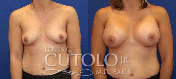 Before & After Breast Augmentation Case 85 View #1 View in Brooklyn, Staten Island, Queens, NY