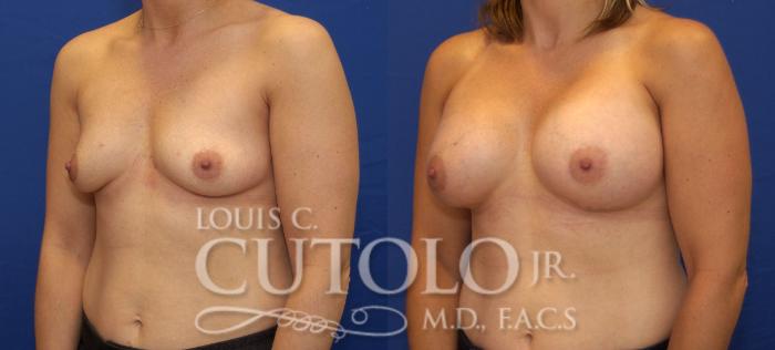Before & After Breast Augmentation Case 85 View #2 View in Brooklyn, Staten Island, Queens, NY