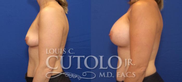 Before & After Breast Augmentation Case 85 View #3 View in Brooklyn, Staten Island, Queens, NY