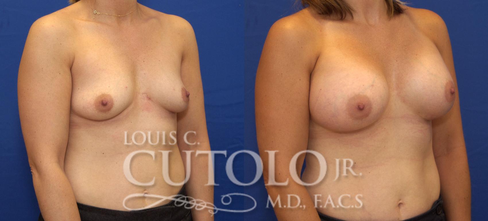 Before & After Breast Augmentation Case 85 View #4 View in Brooklyn, Staten Island, Queens, NY