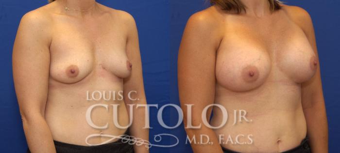 Before & After Breast Augmentation Case 85 View #4 View in Brooklyn, Staten Island, Queens, NY