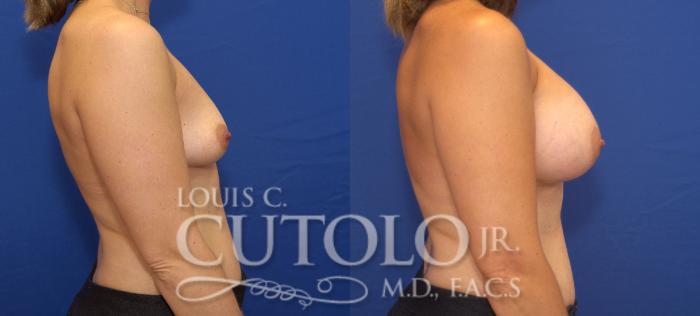 Before & After Breast Augmentation Case 85 View #5 View in Brooklyn, Staten Island, Queens, NY
