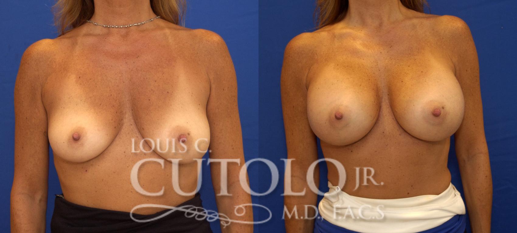 Before & After Breast Augmentation Case 87 View #1 View in Brooklyn, Staten Island, Queens, NY