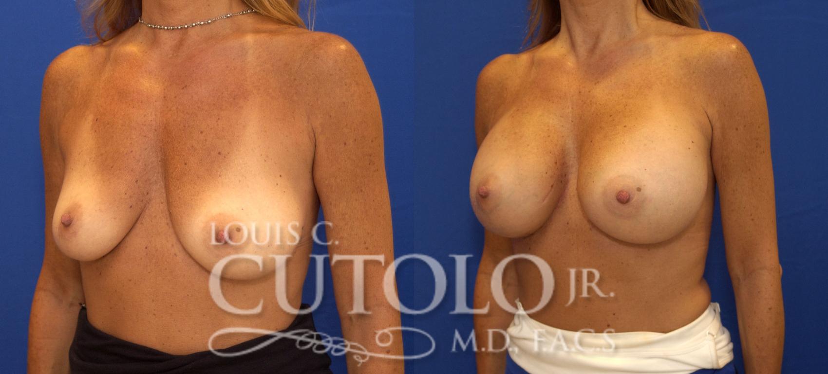 Before & After Breast Augmentation Case 87 View #2 View in Brooklyn, Staten Island, Queens, NY