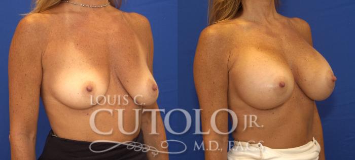 Before & After Breast Augmentation Case 87 View #4 View in Brooklyn, Staten Island, Queens, NY