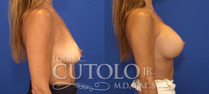 Before & After Breast Augmentation Case 87 View #5 View in Brooklyn, Staten Island, Queens, NY