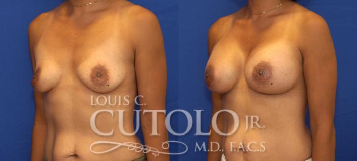 Before & After Breast Augmentation Case 88 View #2 View in Brooklyn, Staten Island, Queens, NY