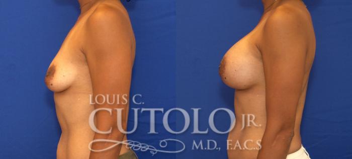 Before & After Breast Augmentation Case 88 View #3 View in Brooklyn, Staten Island, Queens, NY