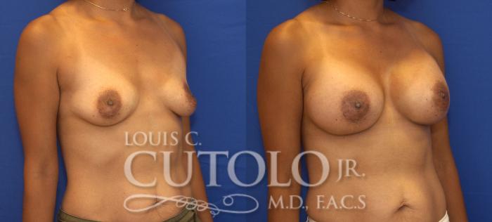 Before & After Breast Augmentation Case 88 View #4 View in Brooklyn, Staten Island, Queens, NY