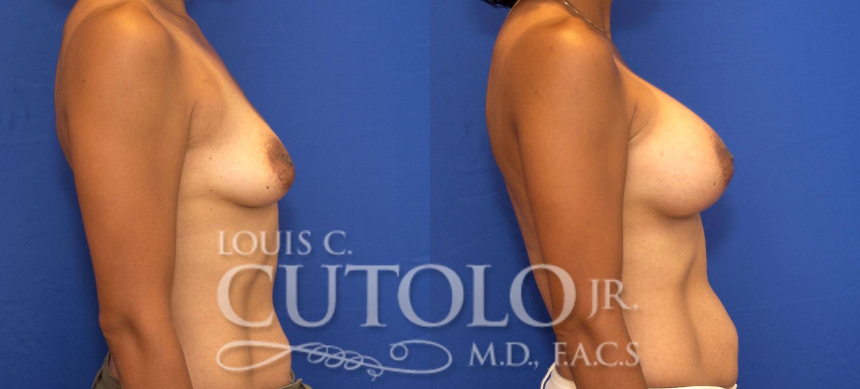 Before & After Breast Augmentation Case 88 View #5 View in Brooklyn, Staten Island, Queens, NY