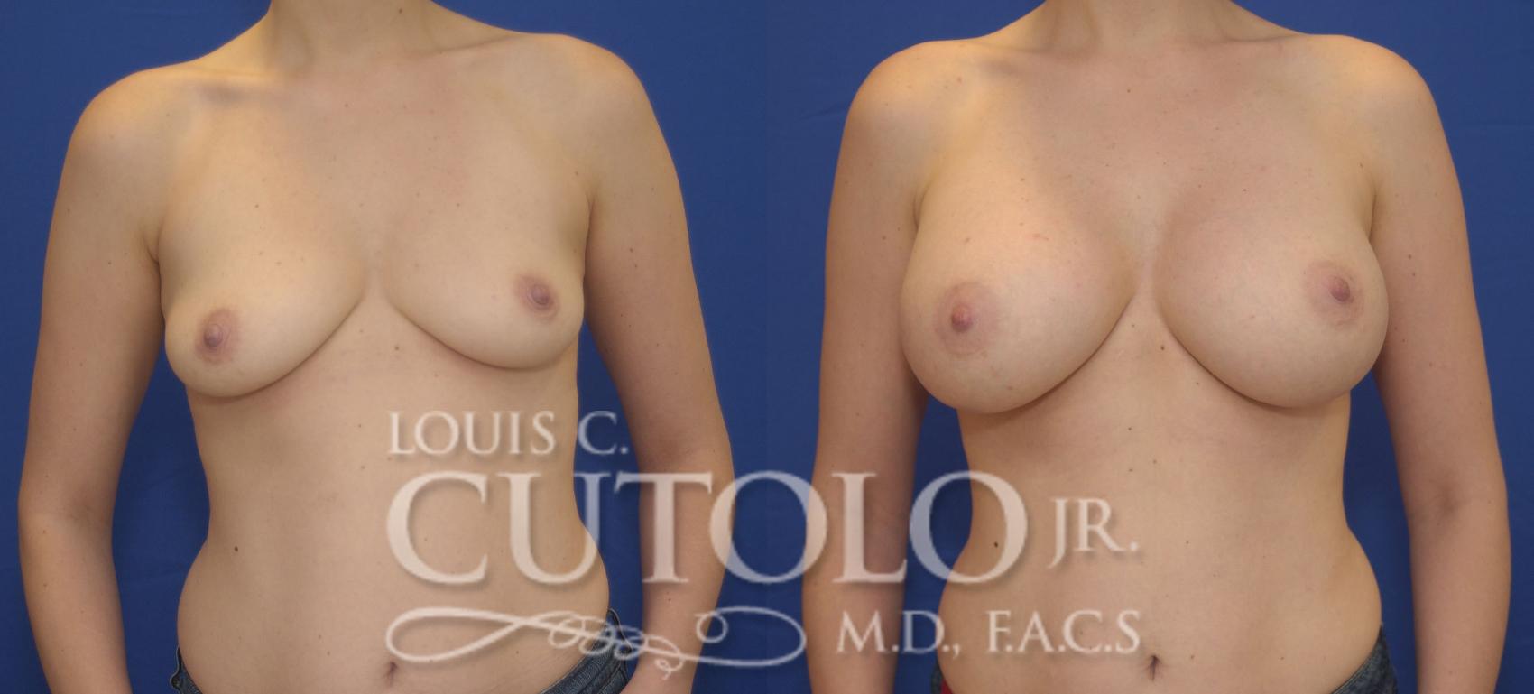 Before & After Breast Augmentation Case 89 View #1 View in Brooklyn, Staten Island, Queens, NY