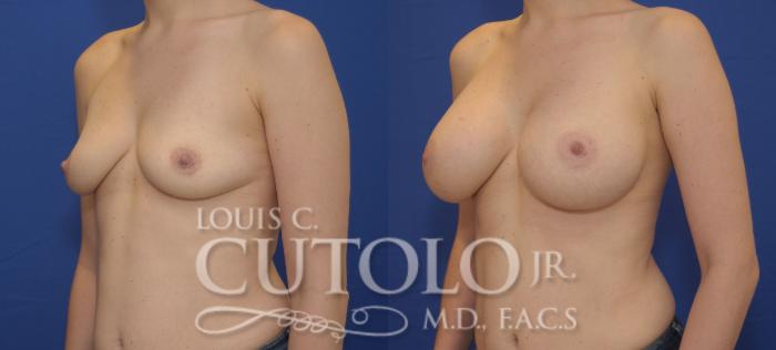 Before & After Breast Augmentation Case 89 View #2 View in Brooklyn, Staten Island, Queens, NY