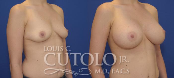 Before & After Breast Augmentation Case 89 View #4 View in Brooklyn, Staten Island, Queens, NY