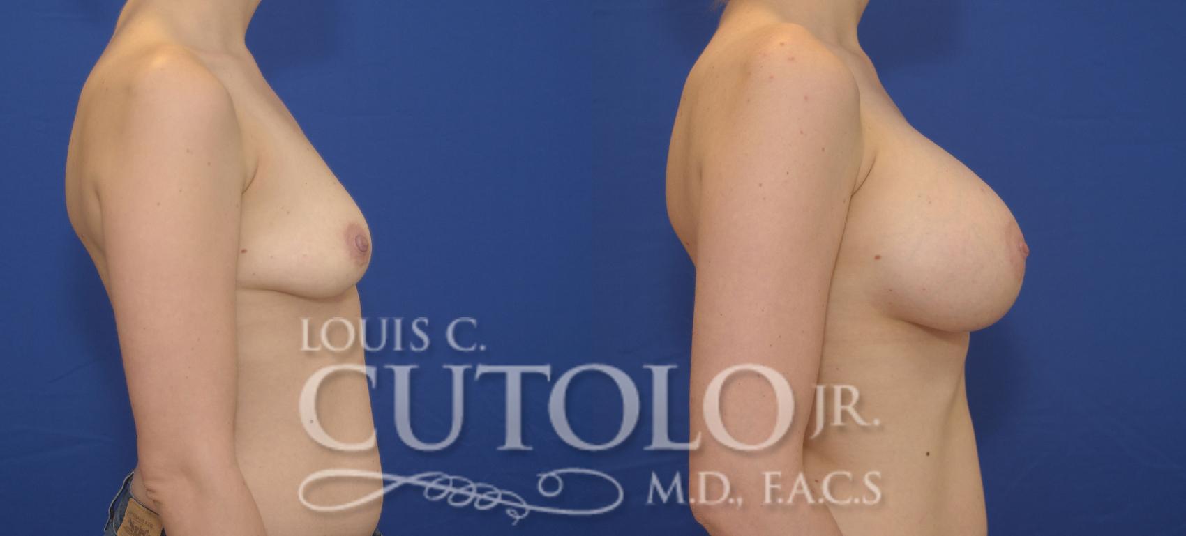 Before & After Breast Augmentation Case 89 View #5 View in Brooklyn, Staten Island, Queens, NY