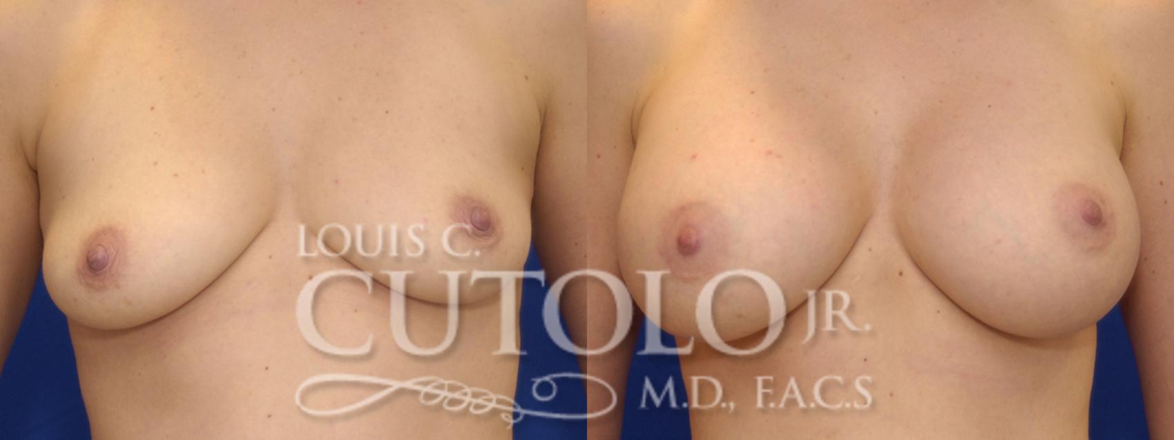 Before & After Breast Augmentation Case 9 View #1 View in Brooklyn, Staten Island, Queens, NY
