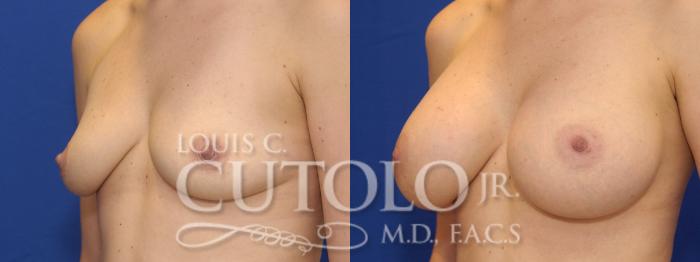 Before & After Breast Augmentation Case 9 View #2 View in Brooklyn, Staten Island, Queens, NY