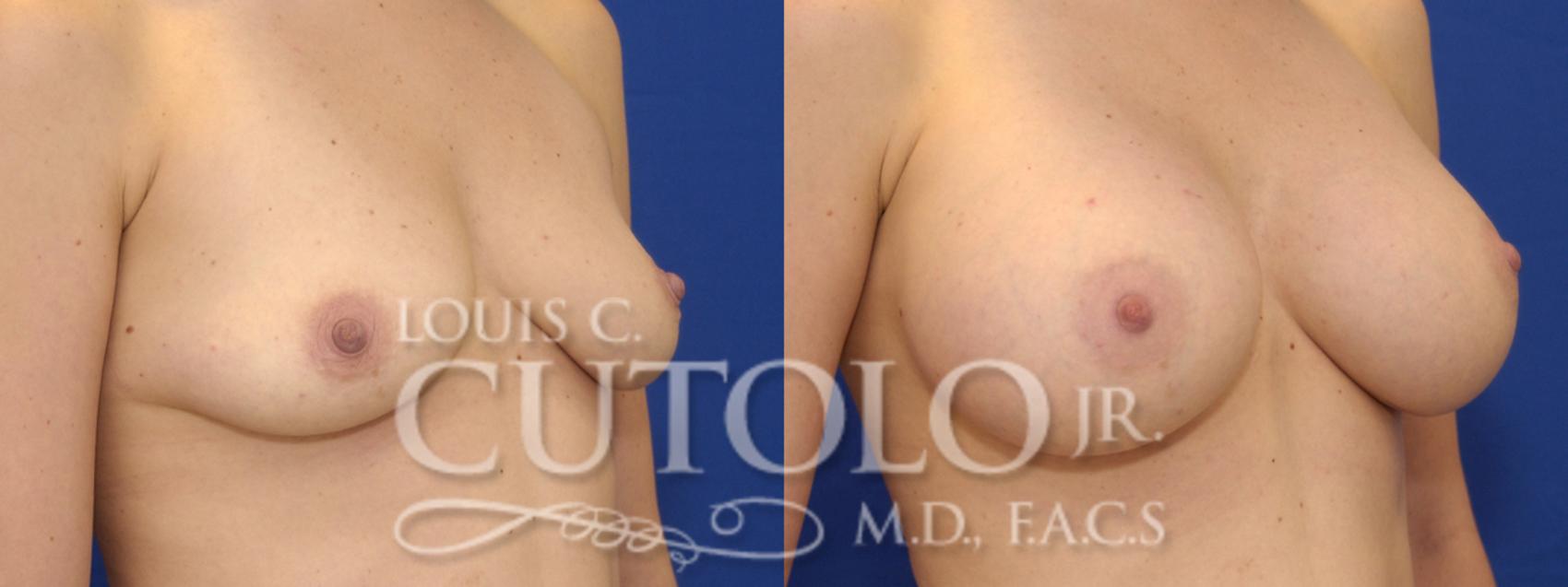 Before & After Breast Augmentation Case 9 View #3 View in Brooklyn, Staten Island, Queens, NY