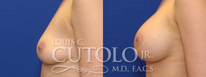 Before & After Breast Augmentation Case 9 View #4 View in Brooklyn, Staten Island, Queens, NY