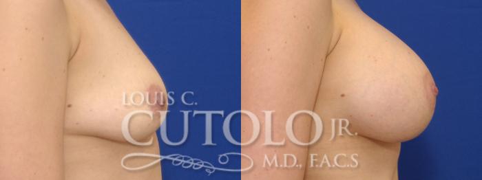 Before & After Breast Augmentation Case 9 View #5 View in Brooklyn, Staten Island, Queens, NY