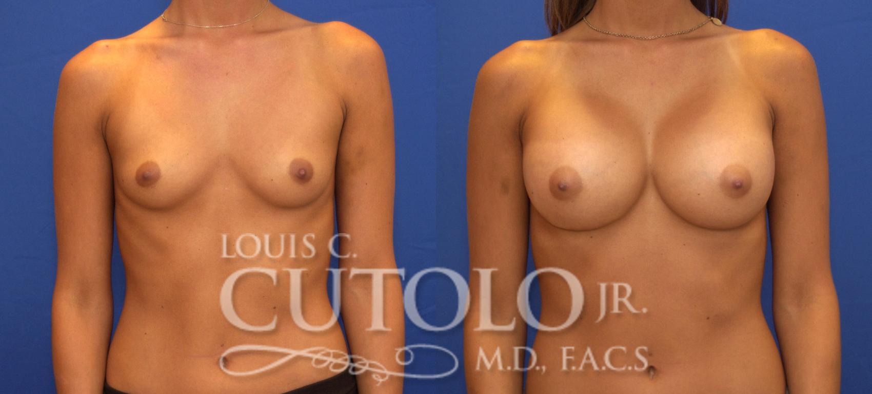 Before & After Breast Augmentation Case 92 View #1 View in Brooklyn, Staten Island, Queens, NY