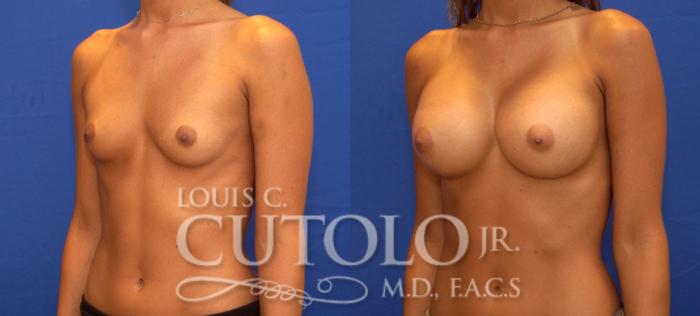 Before & After Breast Augmentation Case 92 View #2 View in Brooklyn, Staten Island, Queens, NY