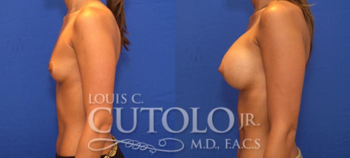 Before & After Breast Augmentation Case 92 View #3 View in Brooklyn, Staten Island, Queens, NY