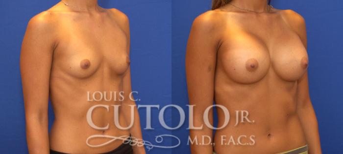 Before & After Breast Augmentation Case 92 View #4 View in Brooklyn, Staten Island, Queens, NY
