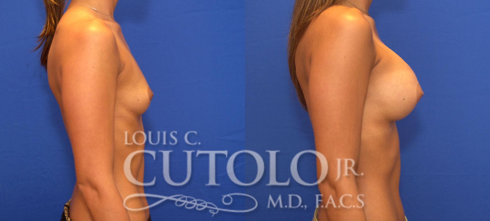 Before & After Breast Augmentation Case 92 View #5 View in Brooklyn, Staten Island, Queens, NY