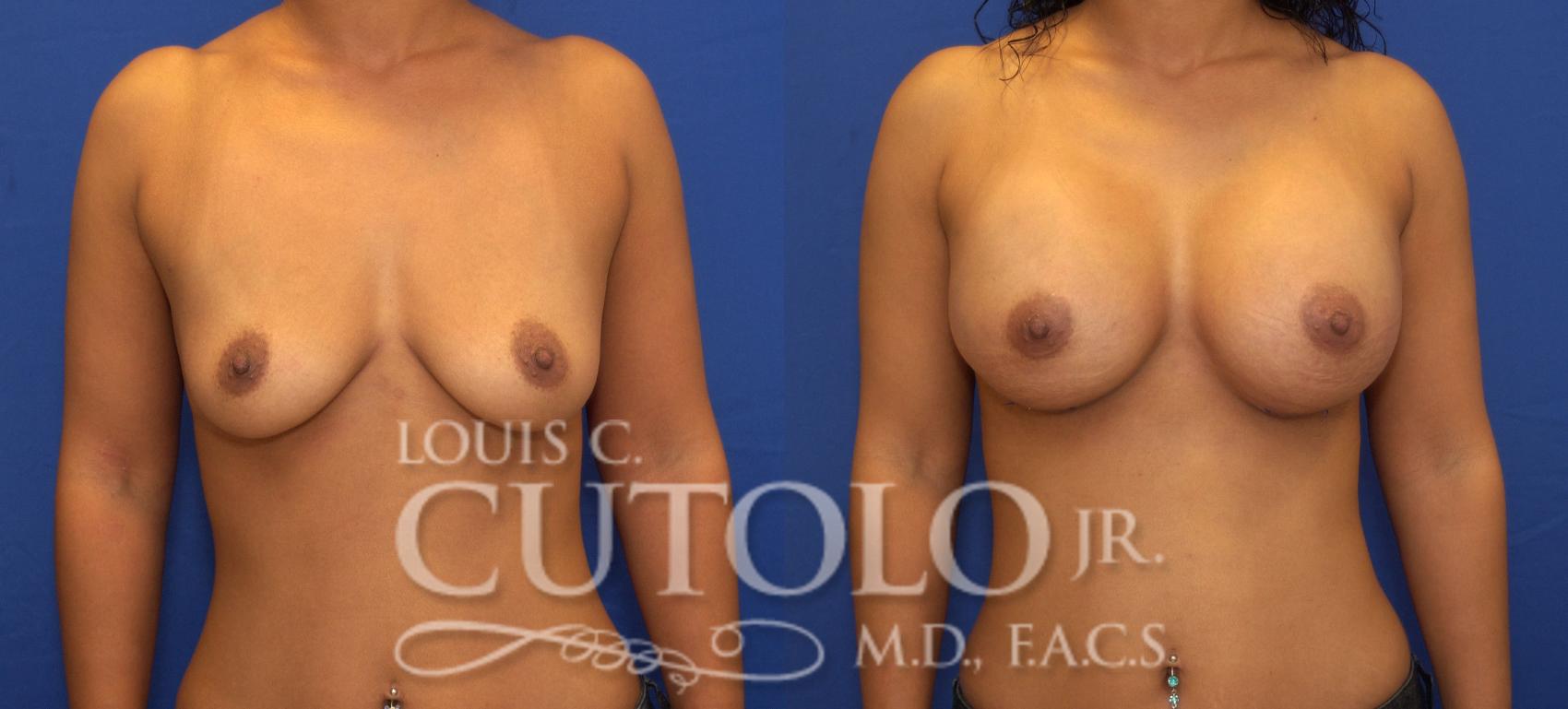 Before & After Breast Augmentation Case 95 View #1 View in Brooklyn, Staten Island, Queens, NY
