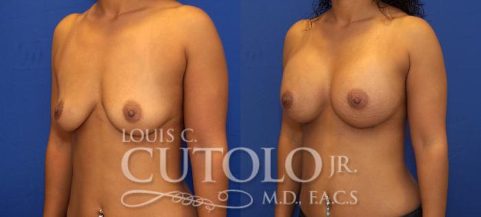 Before & After Breast Augmentation Case 95 View #2 View in Brooklyn, Staten Island, Queens, NY