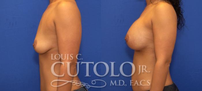 Before & After Breast Augmentation Case 95 View #3 View in Brooklyn, Staten Island, Queens, NY