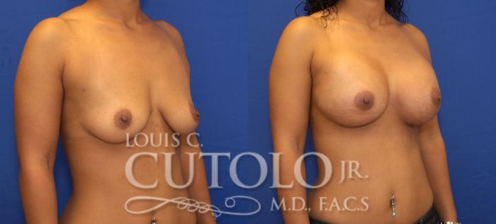 Before & After Breast Augmentation Case 95 View #4 View in Brooklyn, Staten Island, Queens, NY