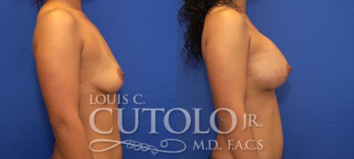 Before & After Breast Augmentation Case 95 View #5 View in Brooklyn, Staten Island, Queens, NY
