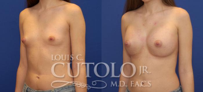 Before & After Breast Augmentation Case 97 View #2 View in Brooklyn, Staten Island, Queens, NY