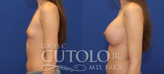 Before & After Breast Augmentation Case 97 View #3 View in Brooklyn, Staten Island, Queens, NY