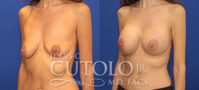 Before & After Breast Augmentation Case 98 View #2 View in Brooklyn, Staten Island, Queens, NY