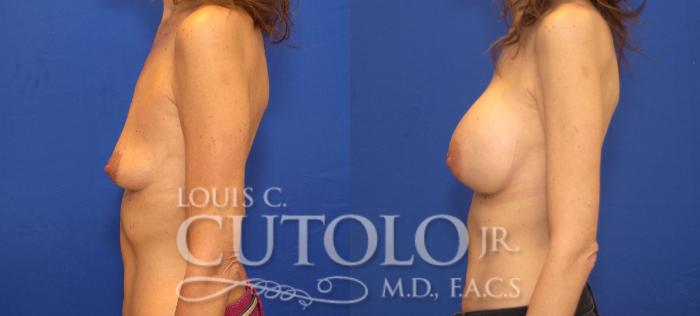 Before & After Breast Augmentation Case 98 View #3 View in Brooklyn, Staten Island, Queens, NY