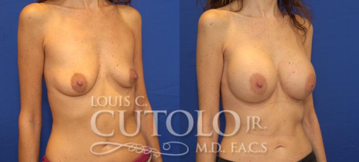 Before & After Breast Augmentation Case 98 View #4 View in Brooklyn, Staten Island, Queens, NY