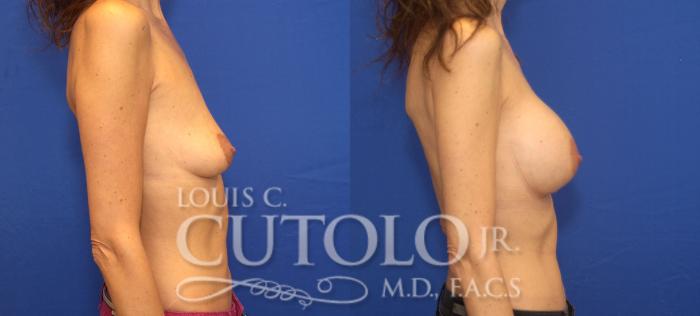 Before & After Breast Augmentation Case 98 View #5 View in Brooklyn, Staten Island, Queens, NY