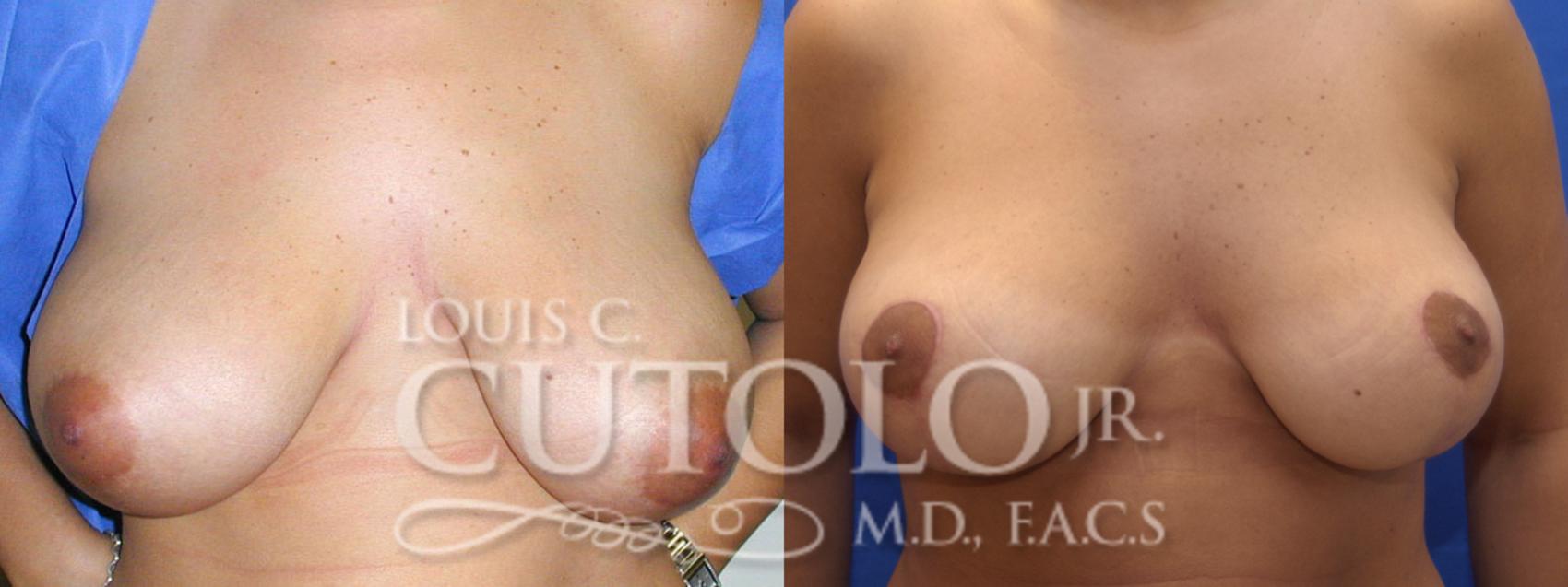 Before & After Breast Lift Case 13 View #1 View in Brooklyn, Staten Island, Queens, NY