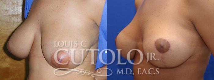 Before & After Breast Lift Case 13 View #2 View in Brooklyn, Staten Island, Queens, NY