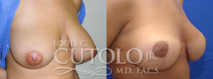 Before & After Breast Lift Case 13 View #3 View in Brooklyn, Staten Island, Queens, NY