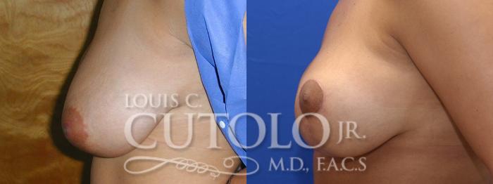 Before & After Breast Lift Case 13 View #4 View in Brooklyn, Staten Island, Queens, NY
