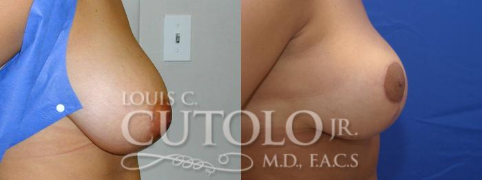Before & After Breast Lift Case 13 View #5 View in Brooklyn, Staten Island, Queens, NY