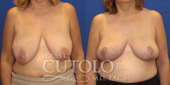 Before & After Breast Lift Case 158 View #1 View in Brooklyn, Staten Island, Queens, NY